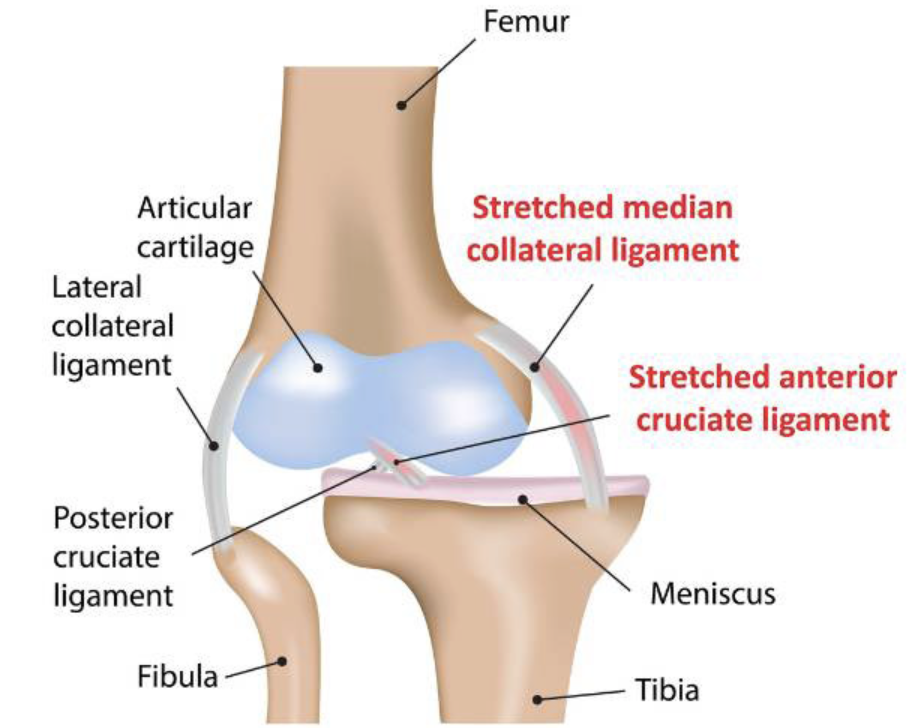 Knee Dislocation
